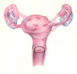 Ce trebuie să știi despre endometrioză 
